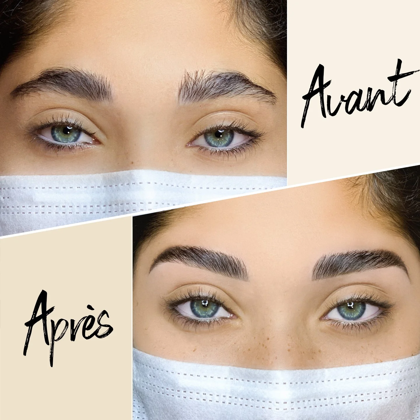 browlift avant apres